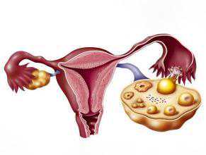 姐妹们哪里能买到供卵&男人冻精子&双侧卵巢多囊样改变？是多囊吗？